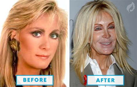 failed plastic surgeries|before and after plastic surgery scam.